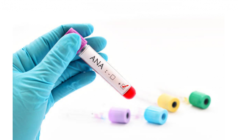 News! Antinuclear Antibody (ANA detect) test Vistamedi